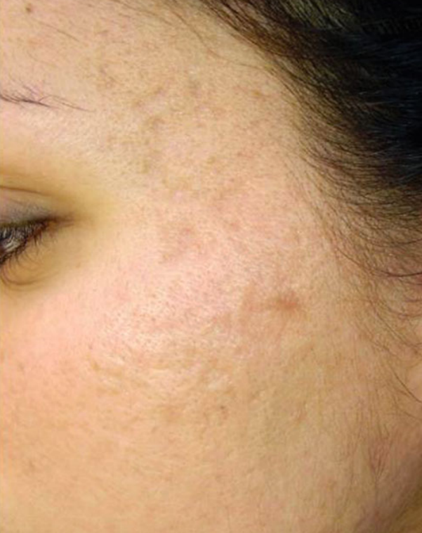 Acne scar after combined treatment