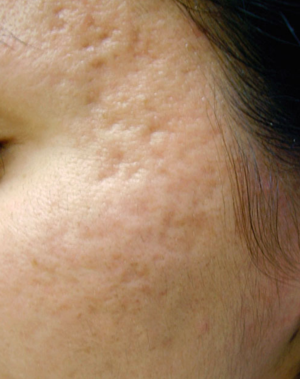 Acne scar before treatment