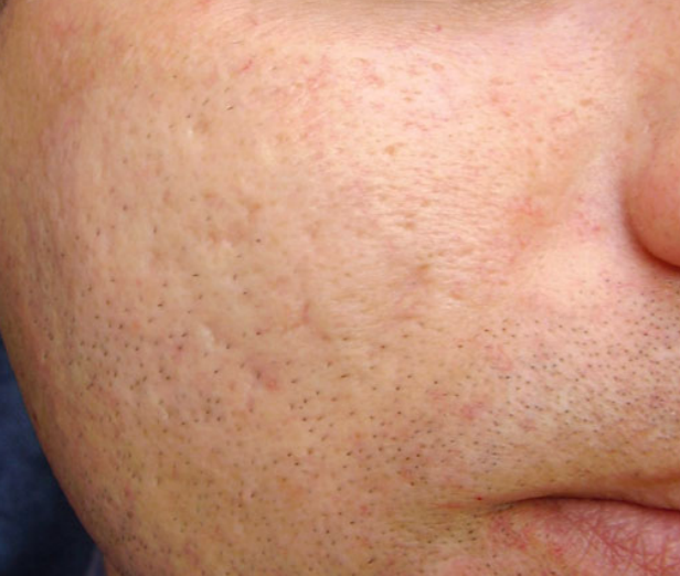 Atrophic post acne scar after laser therapy