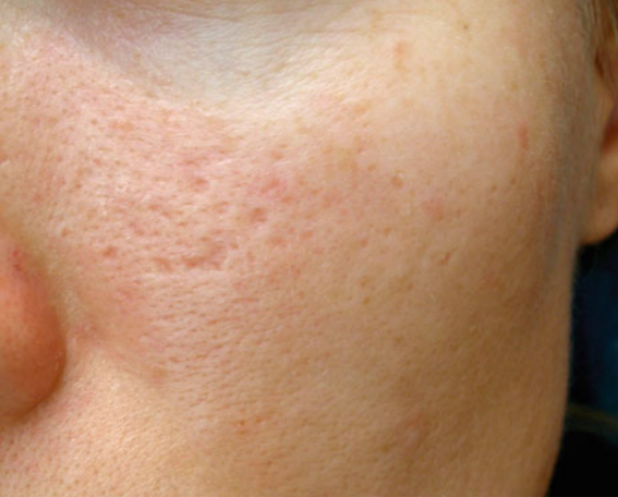 Atrophic post acne scar after Microdermabration