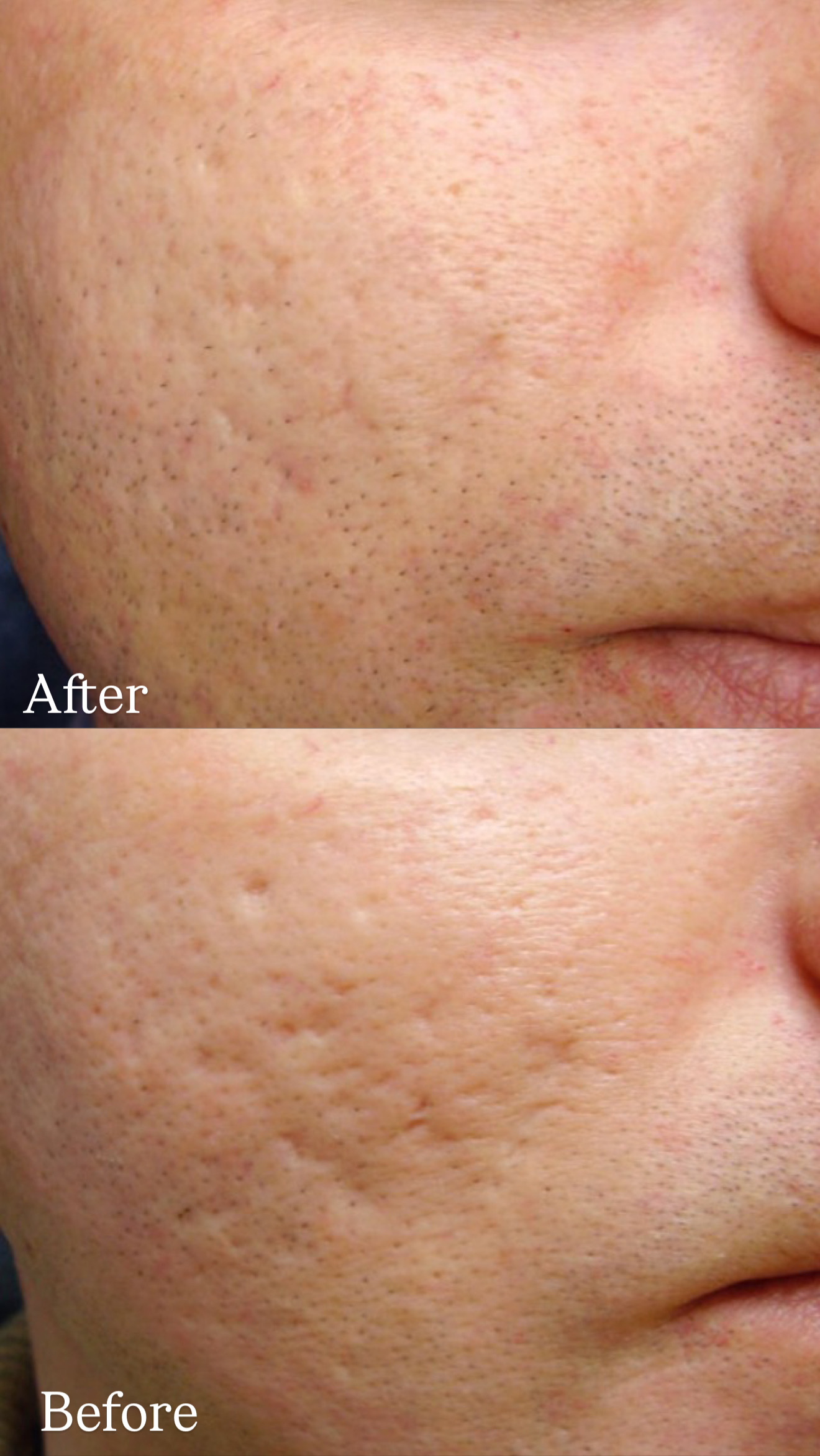 Atrophic Post Acne Scar before and after Laser Therapy