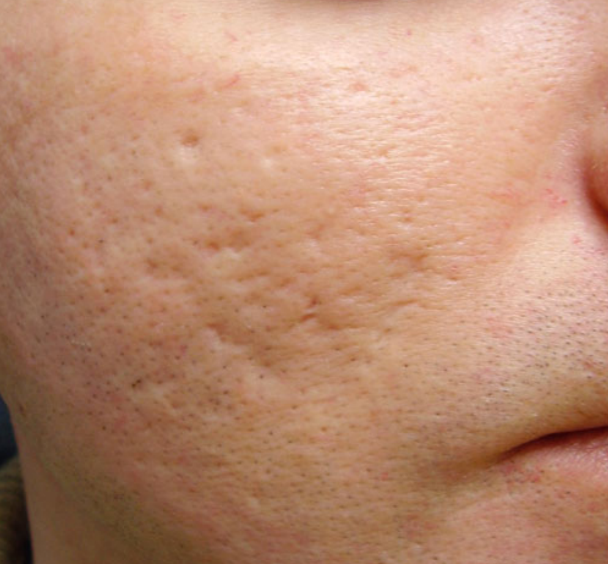 Atrophic post acne scar before laser therapy