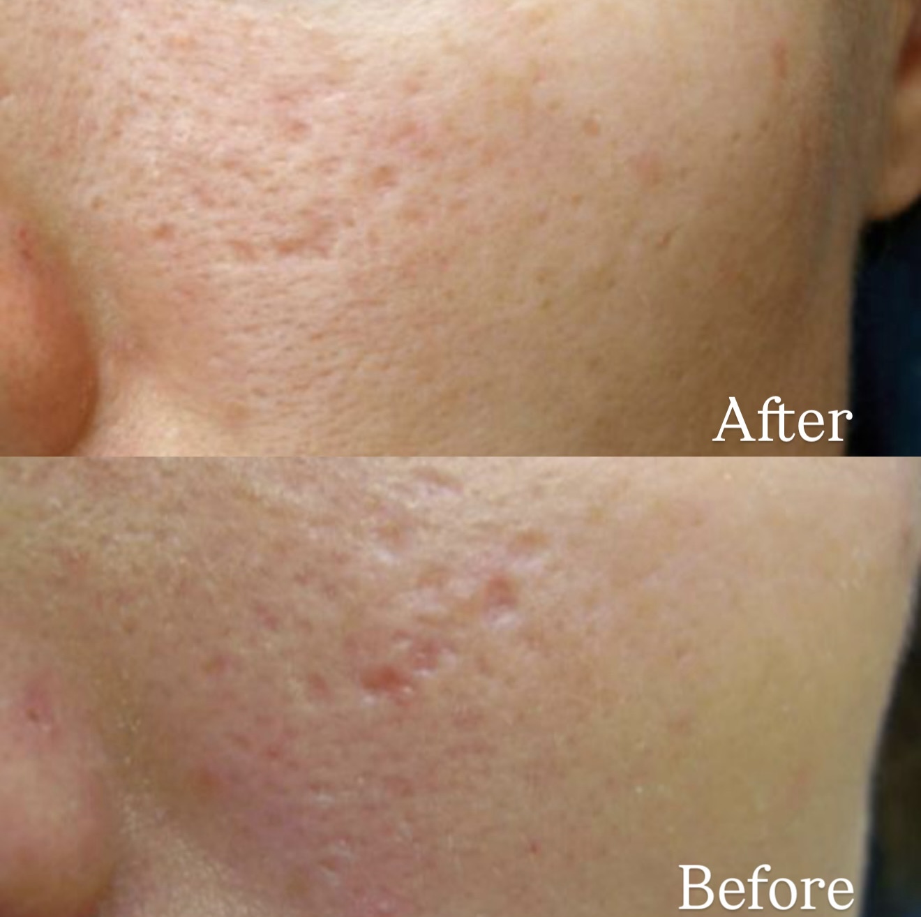 Atrophic Postacne Scar before and after Microdermabration treatment
