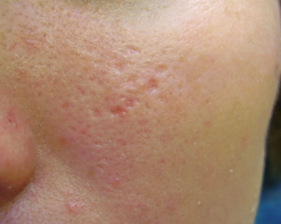Atrophic post acne scar before Microdermabration