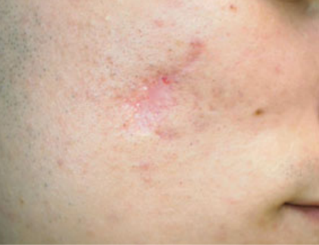 Atrophic scar after combined treatment
