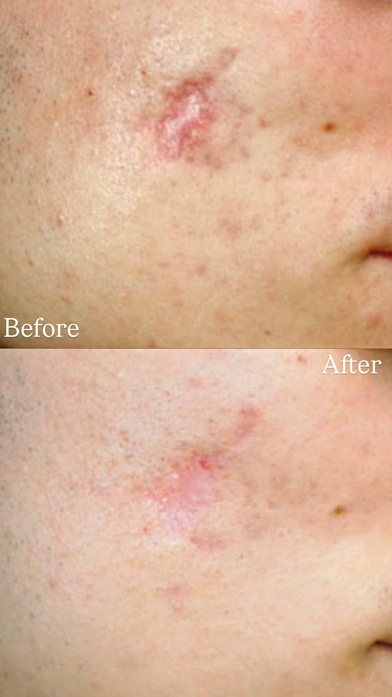 Atrophic Scar before and after combined treatments