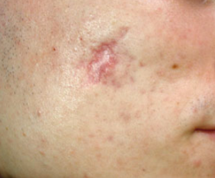 Atrophic scar before treatment