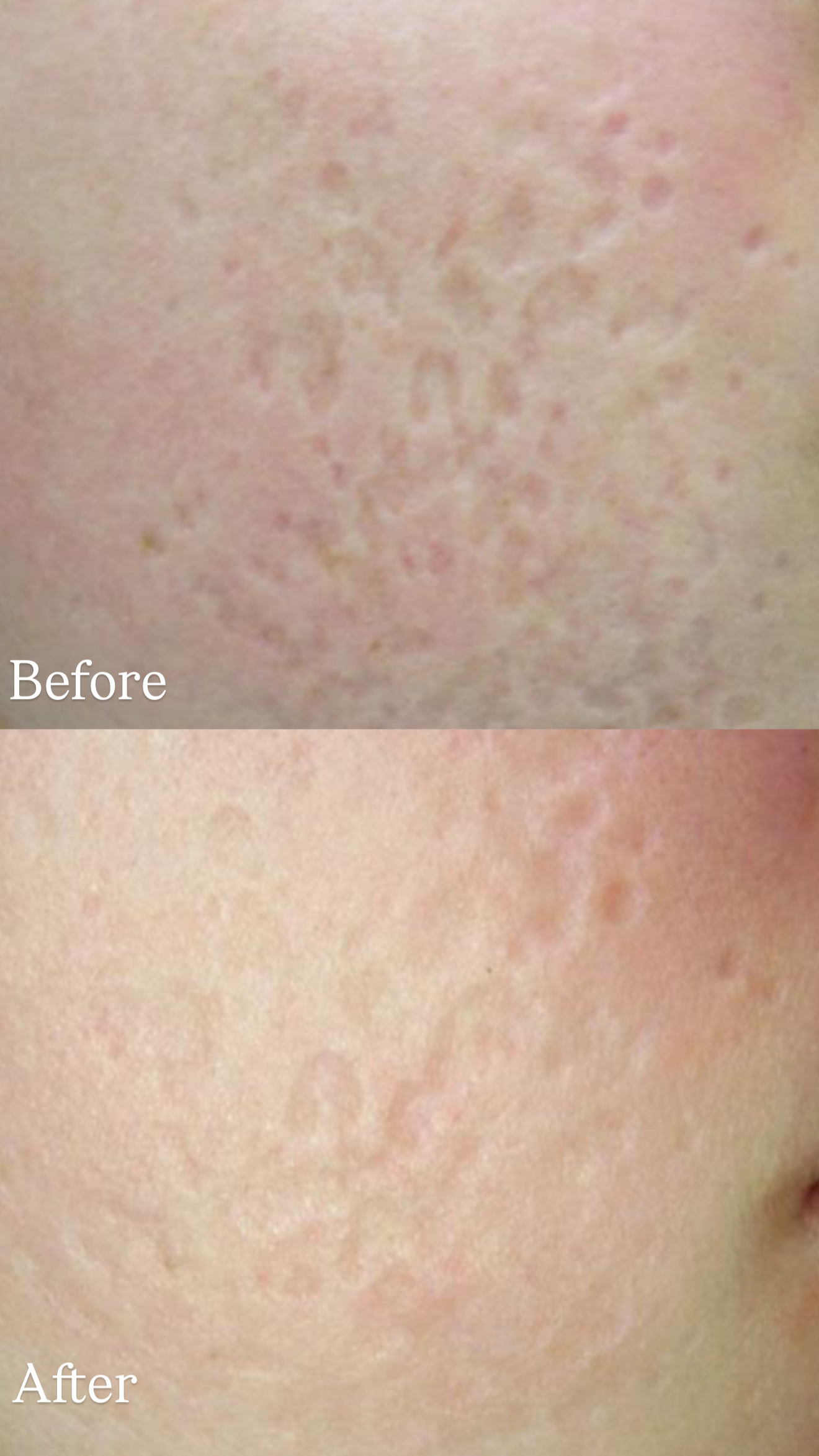 Atrophic Scars before and after Subcision Therapy