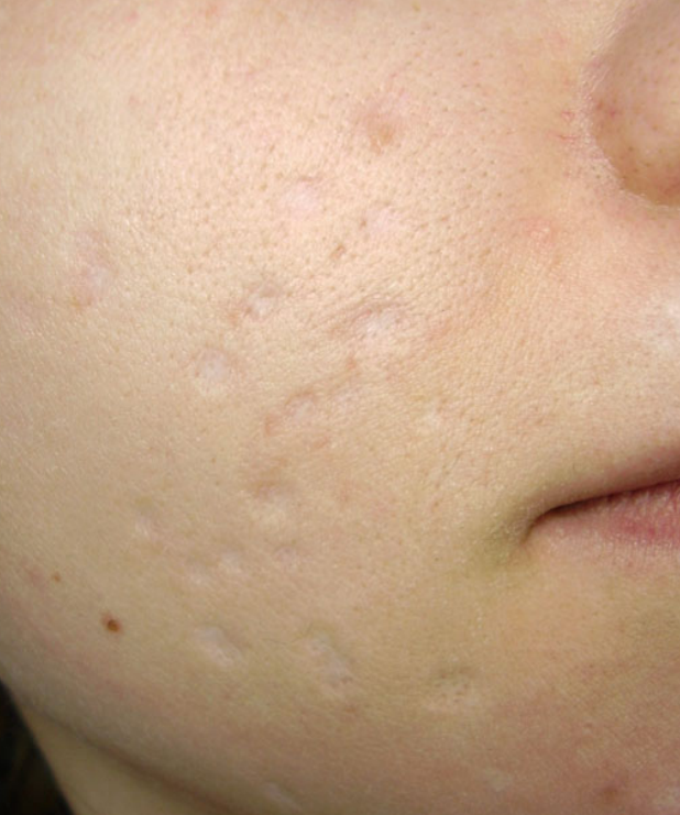 atrophic scars after subcision therapy