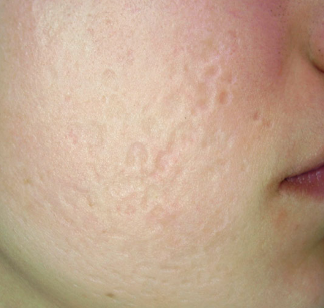 Atrophic scars after subcision