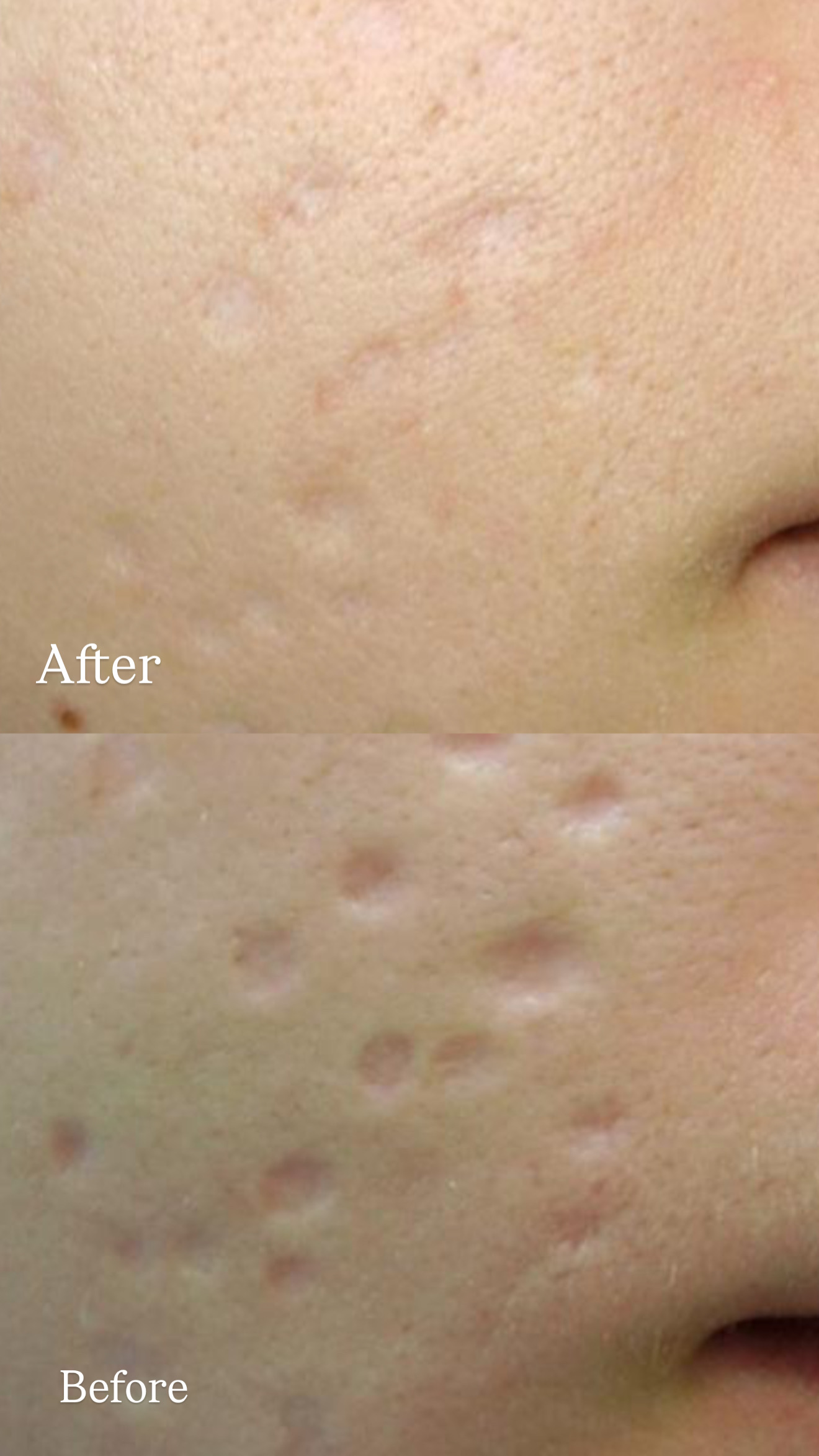 Atrophic Acne Scars before and after Subcision Therapy