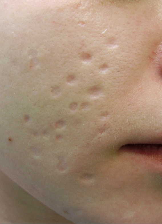 atrophic scars before subcision therapy