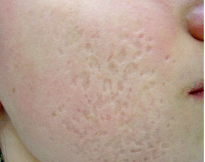 Atrophic scars before subcision