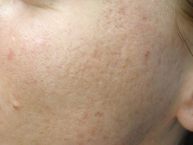 Atrophic skin scar after collagen induction therapy