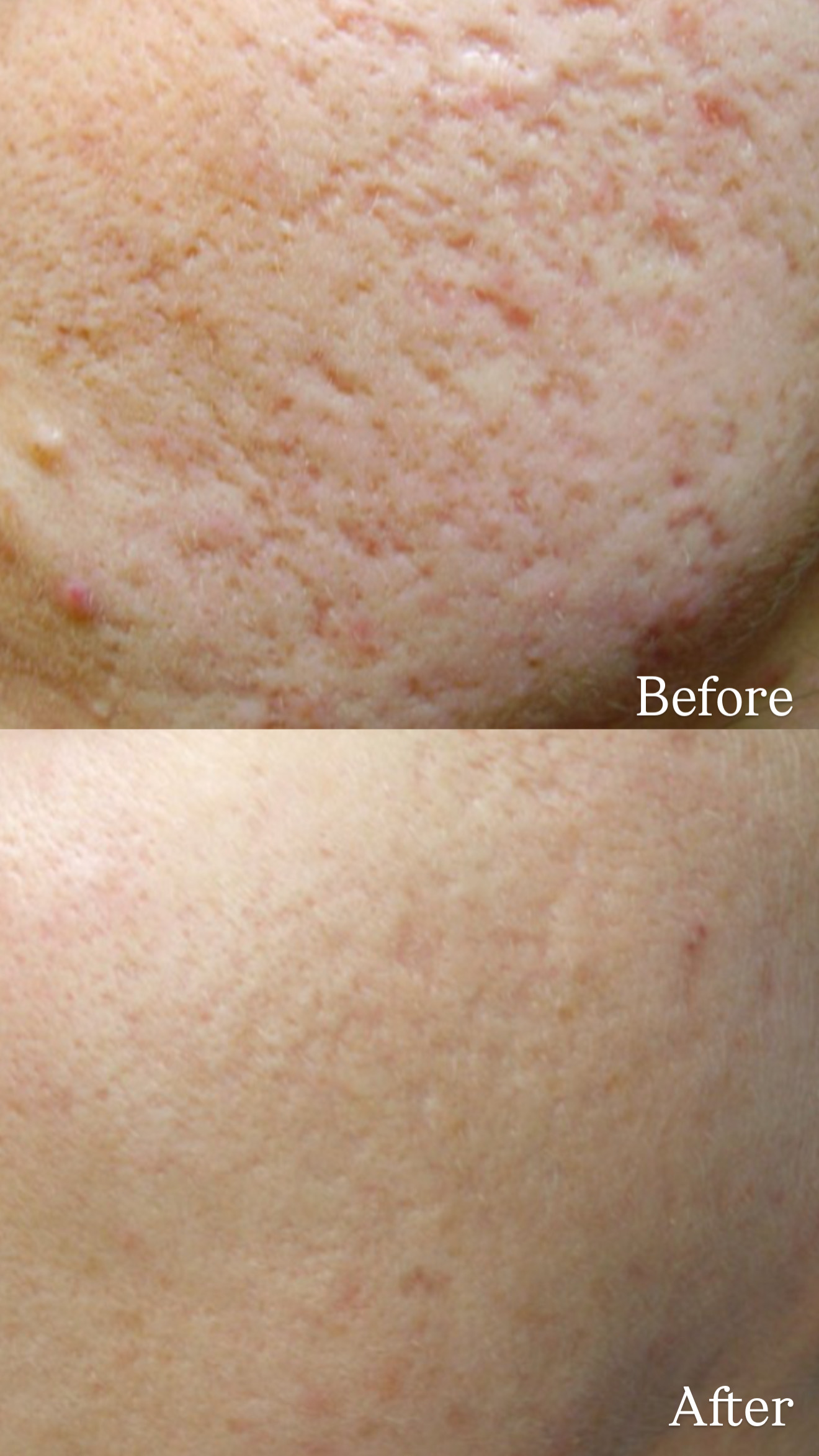 Atrophic Acne Scar before and after Collagen Induction Therapy