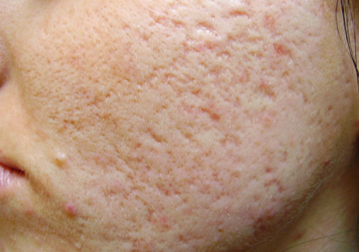 Atrophic skin scar before collagen induction therapy