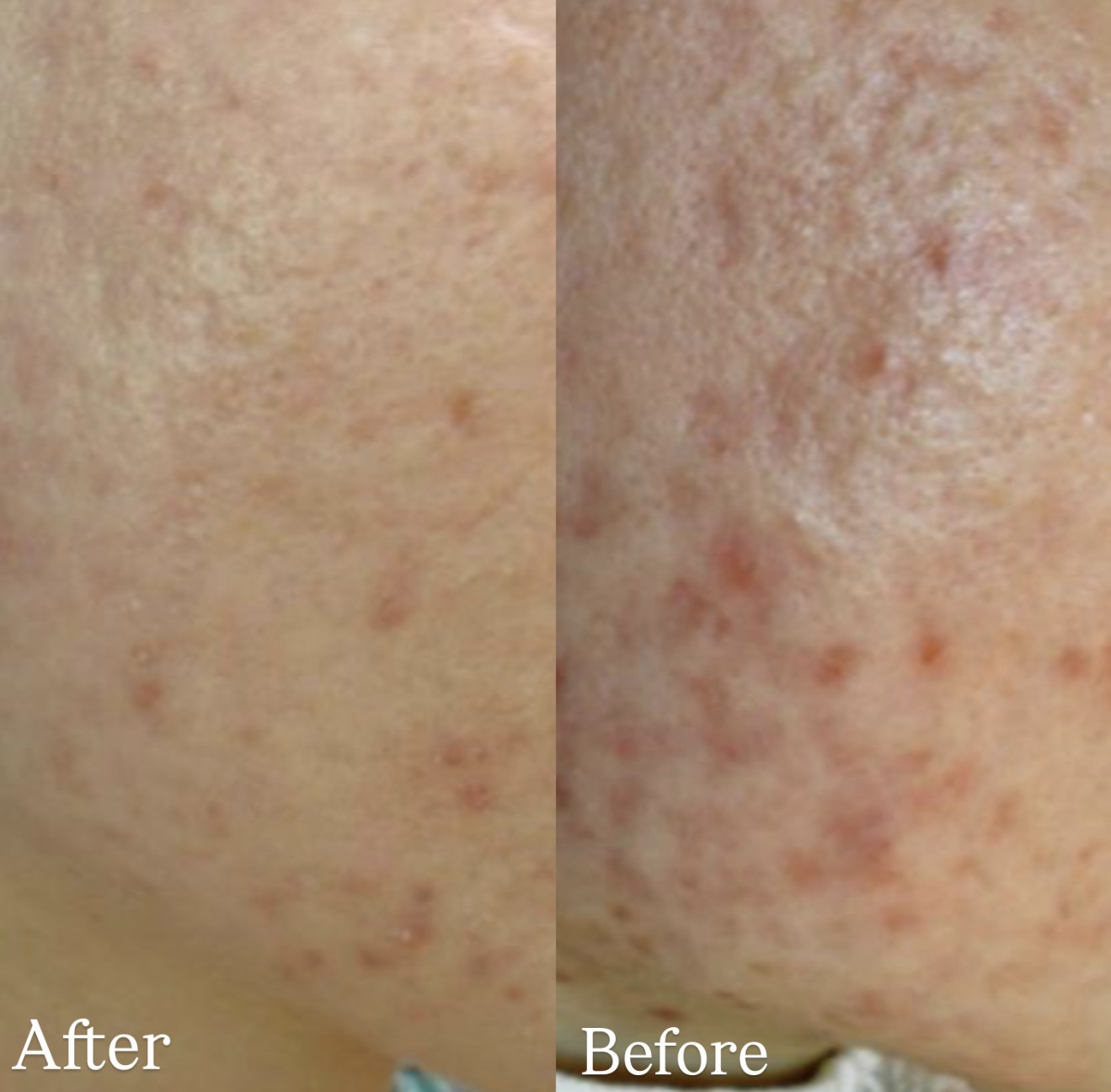 Fresh Postacne Scars before and after combined treatments