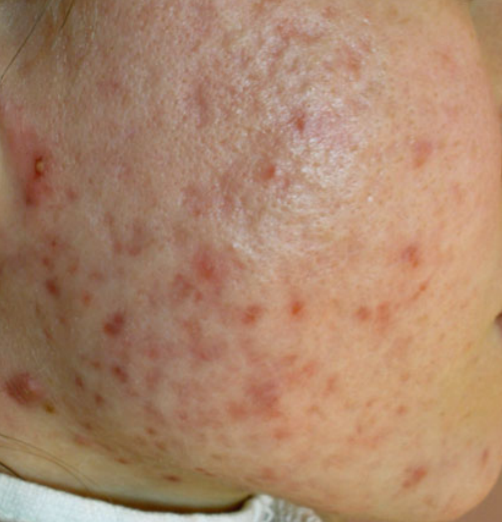 Fresh postacne scars before treatment