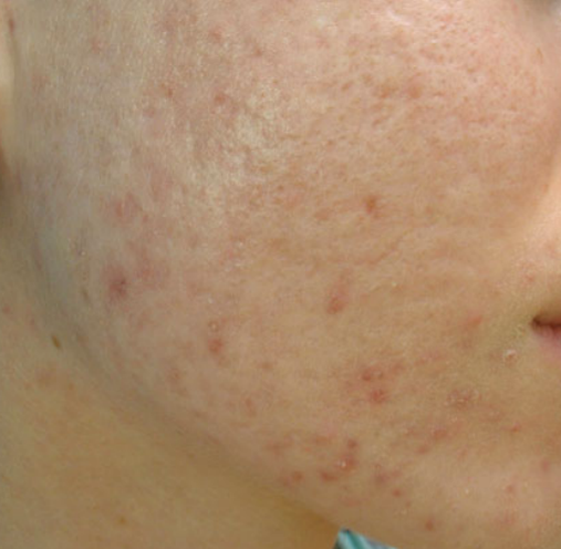 postacne scars after combined treatment
