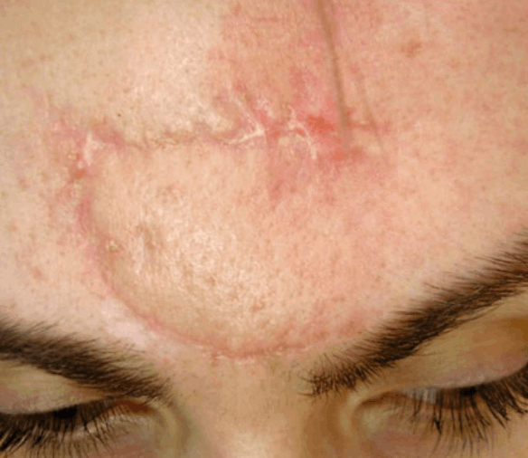 Fresh scar after melanoma extensive excision before