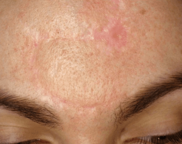 scar of melanoma extensive excision after combined treatment