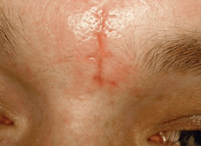 Postsurgery scar before