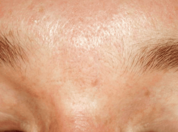 Postsurgery scar after combined treatment
