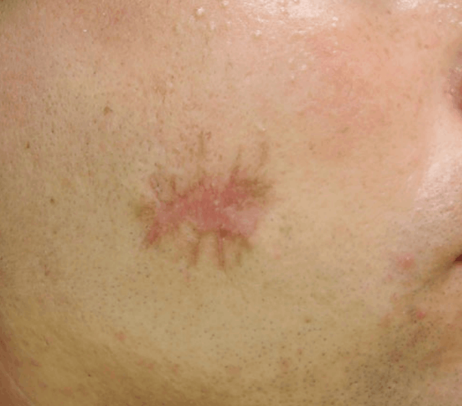 Postsurgery scar before TCA peel