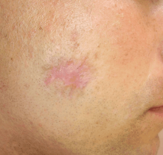 Postsurgery scar after TCA peel