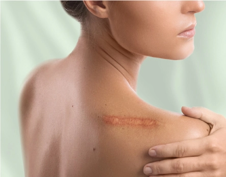 Trauma & Burn Scars 