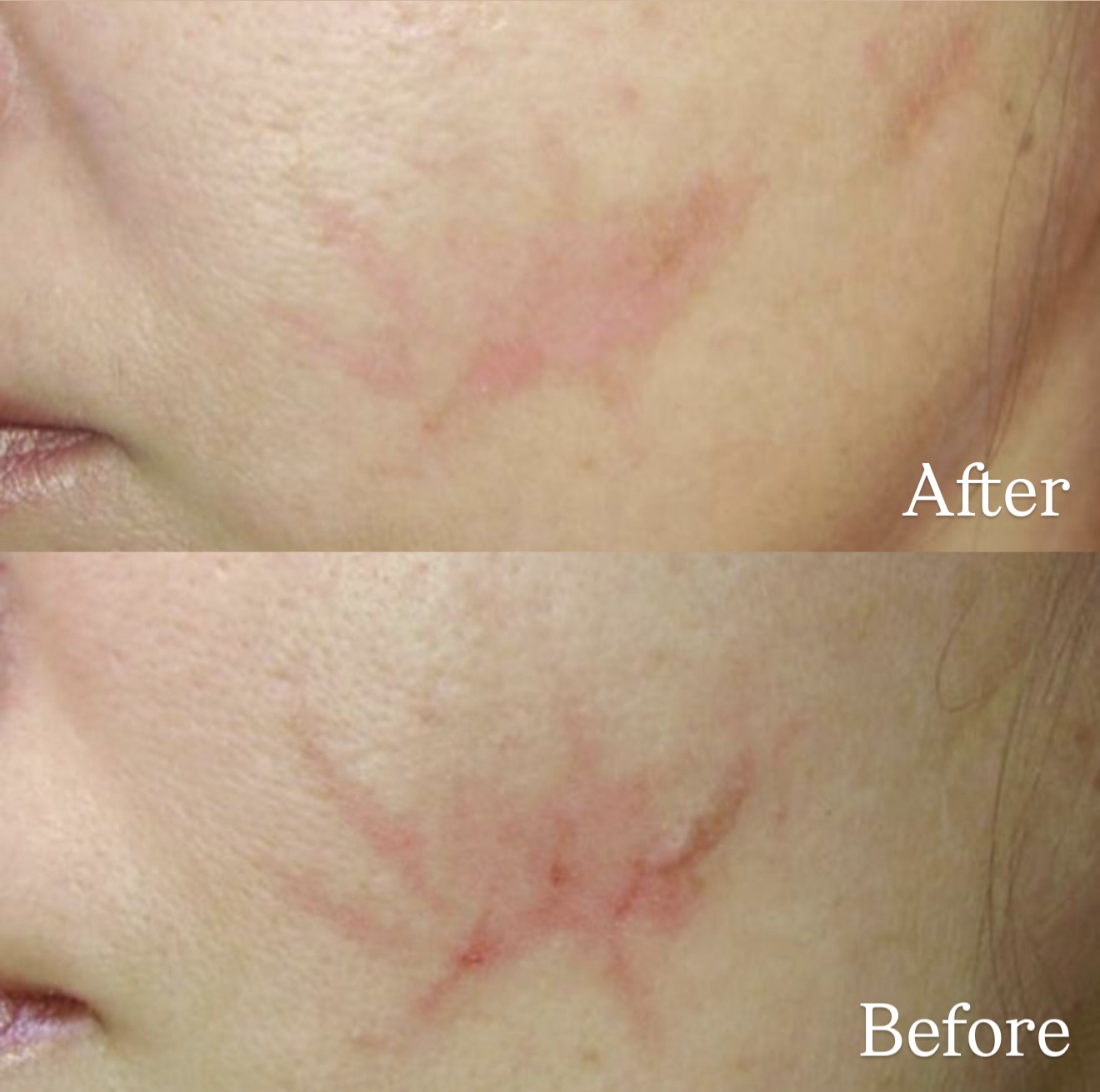 Postinjury Scar before and after Peel treatment