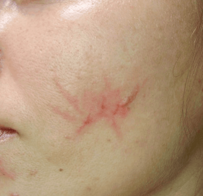 Postinjury scar before Chemical Peel