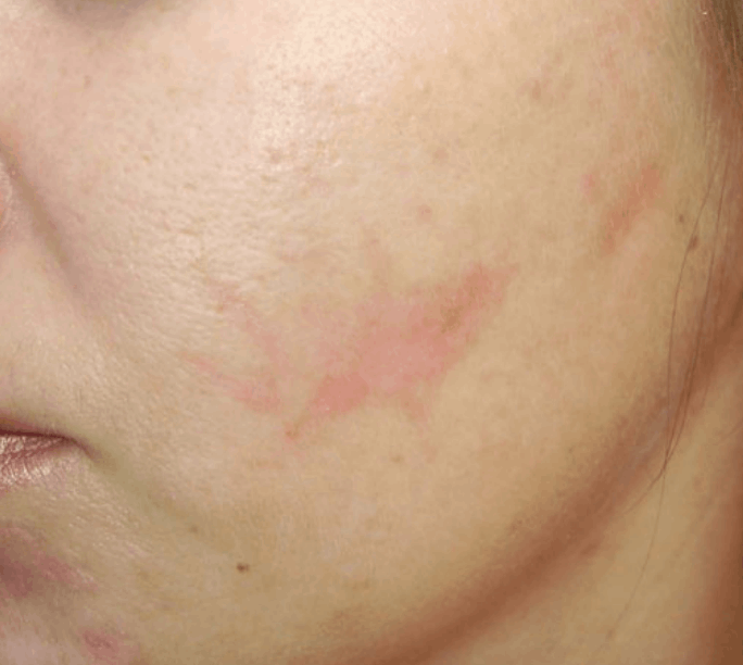 Postinjury scar after Chemical Peel