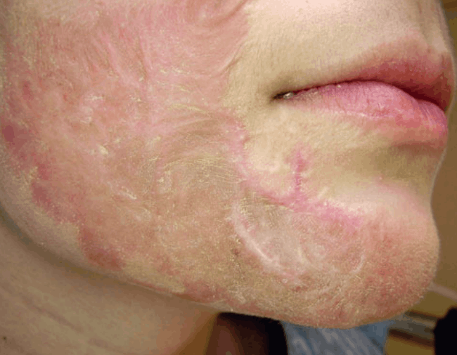 Postburn keloid before