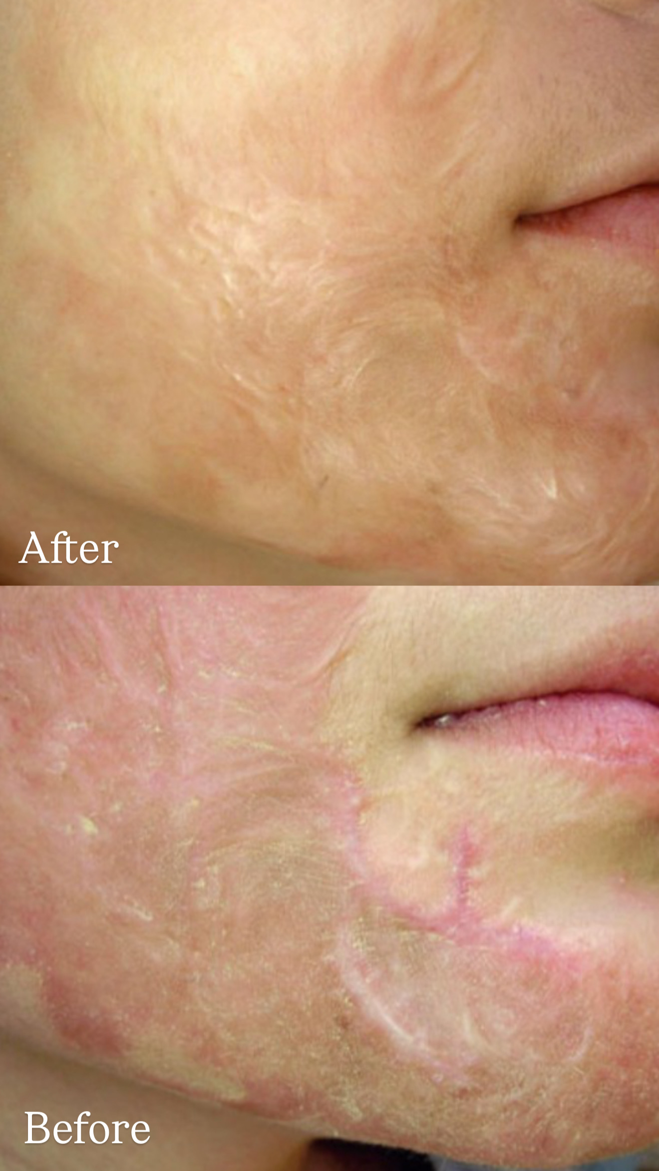 Postburn Keloid Scar before and after combined treatments
