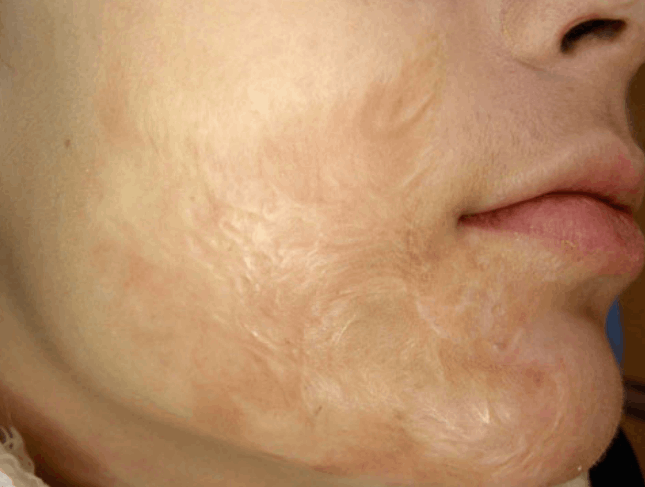 Postburn keloid after combined treatment