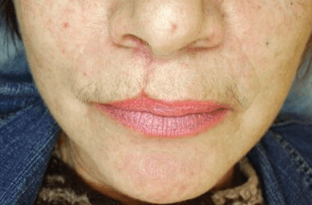 Postinjury atrophic scar before