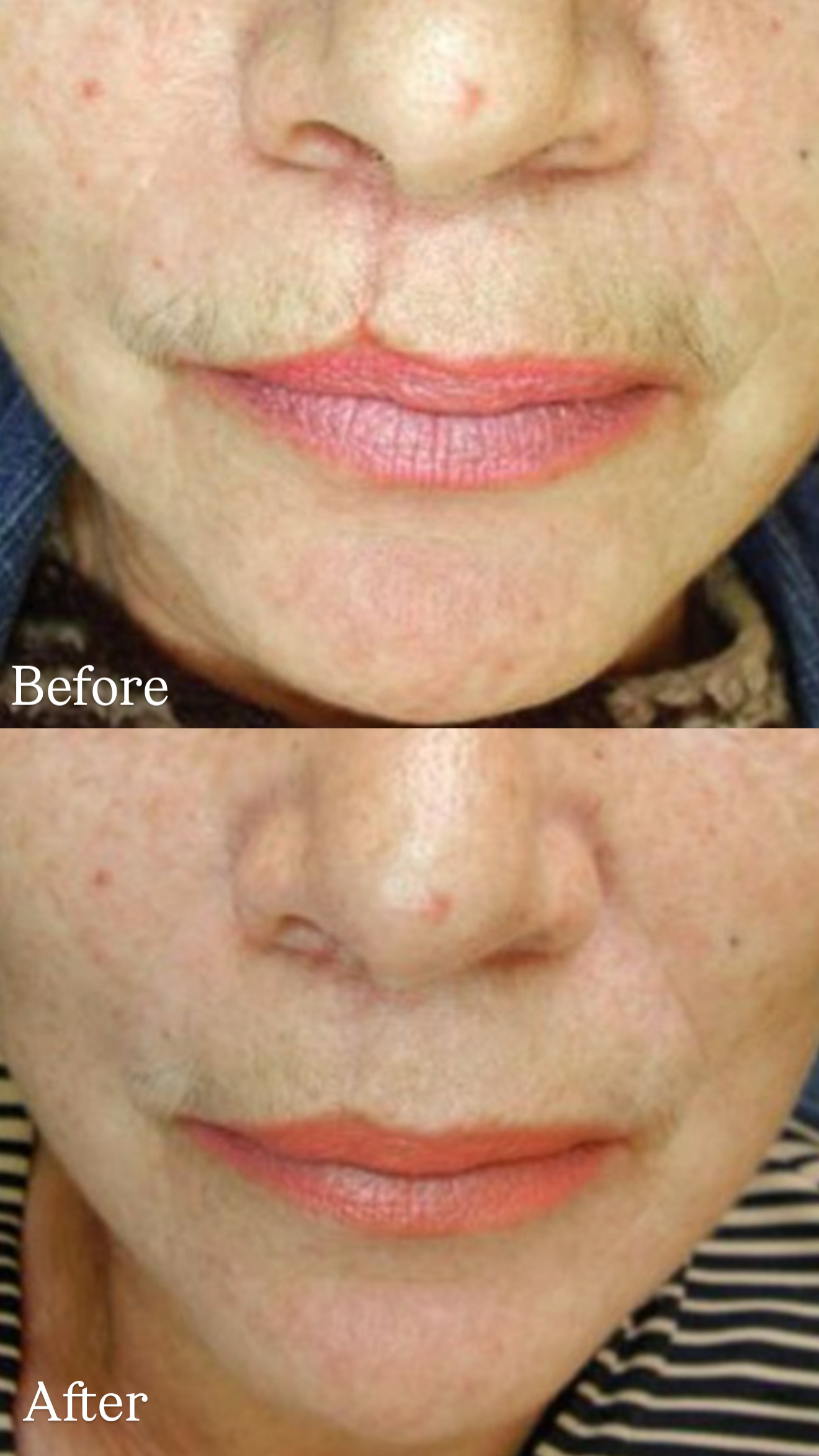 Postinjury Atrophic Scar before and after combined treatments