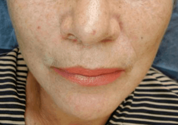 Postinjury atrophic scar after combined treatment