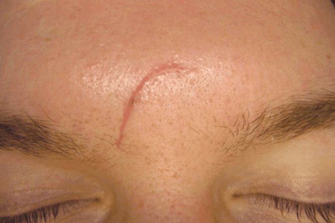 Postinjury scar before microdermabrasion
