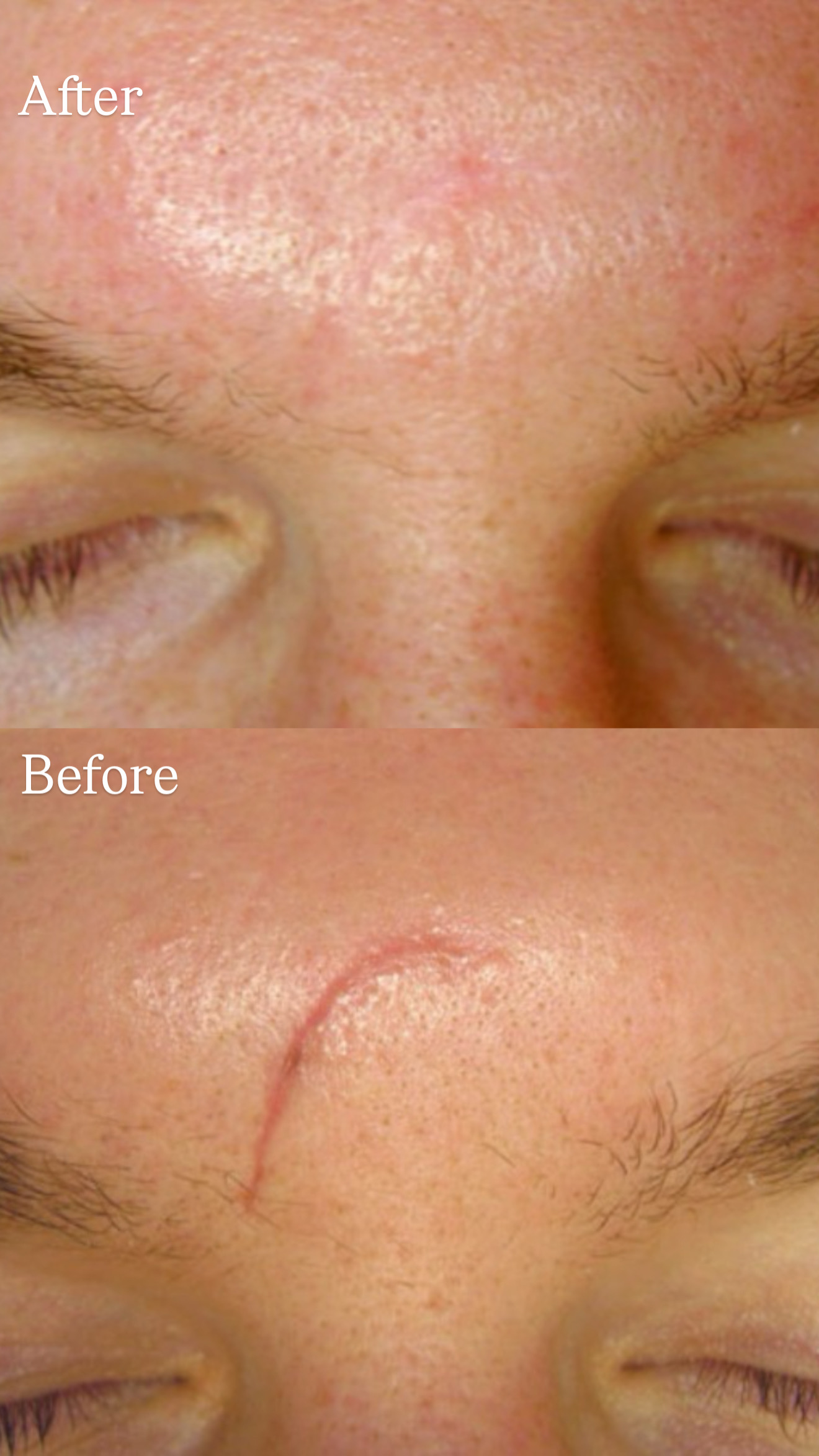 Postinjury Scar before and after microdermabrasion treatment