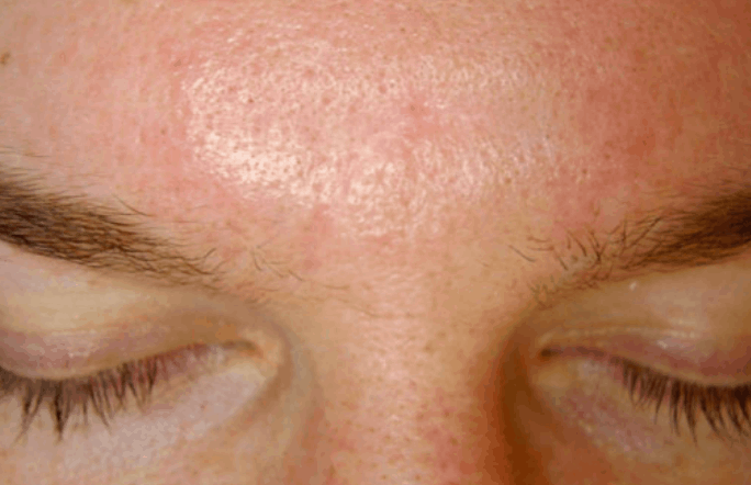 Postinjury scar after microdermabrasion