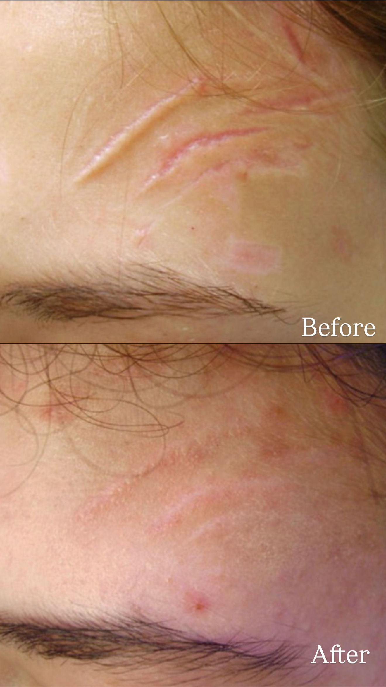Postinjury Scar before and after combined treatments