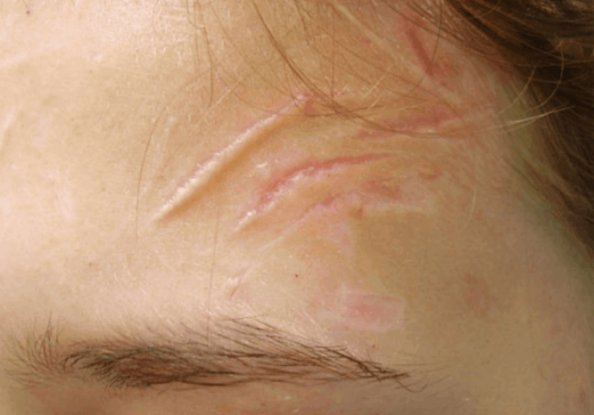 postinjury scar before