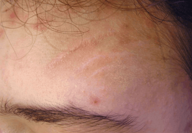 postinjury scar after combined treatment