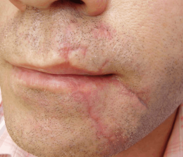Postinjury scars before