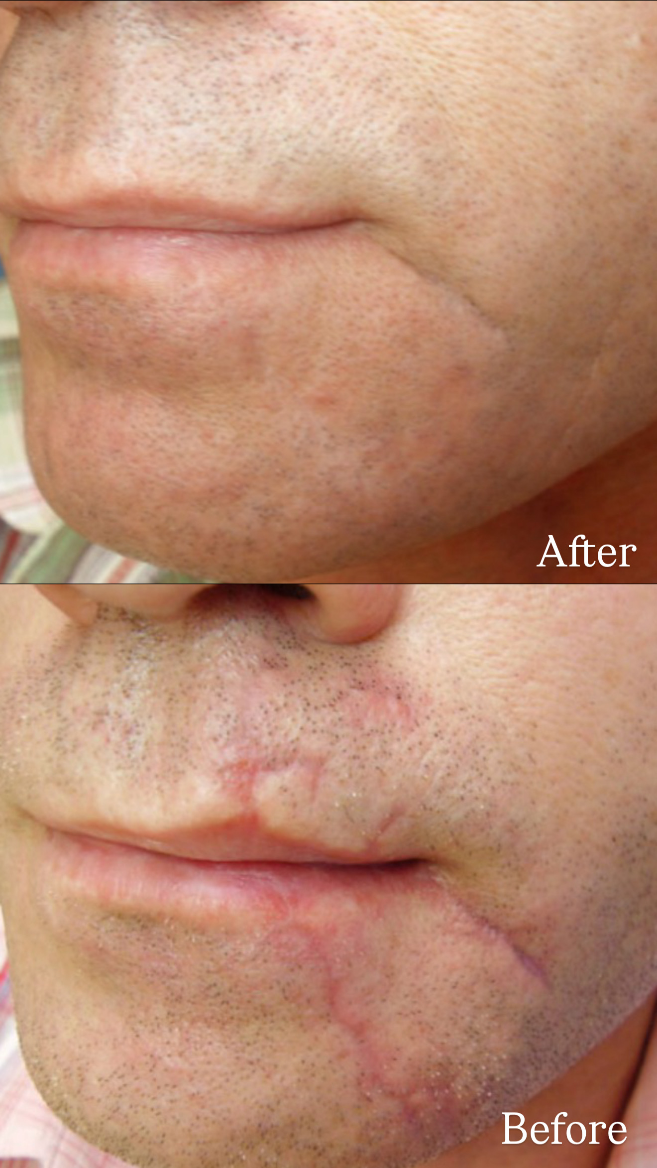 Postinjury Scar before and after combined treatments 