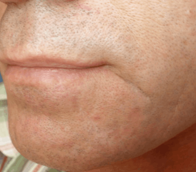 Postinjury scars after combined treatment