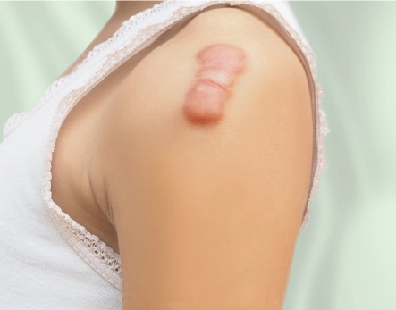 Keloid & Hypertrophic Scars 