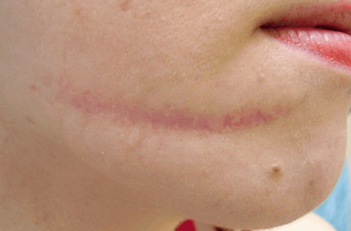 hypertrophic scar of the chin region after combined treatment